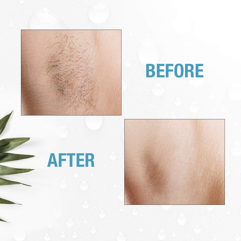 Clean & Easy Non-Laser Personal Electrolysis for Face and Body